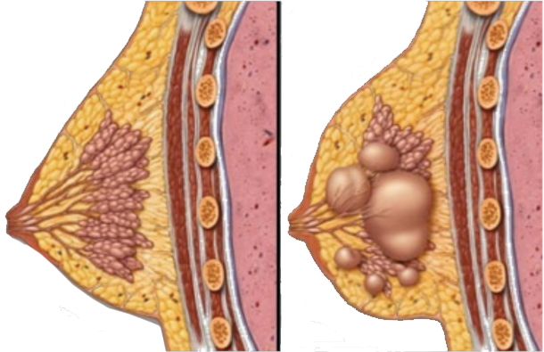 fibrocystic-breast-disease