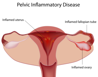 pelvic-inflammatory-disease