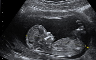 What to Expect During Your Ultrasound