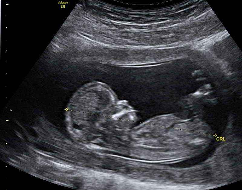What to Expect During Your Ultrasound