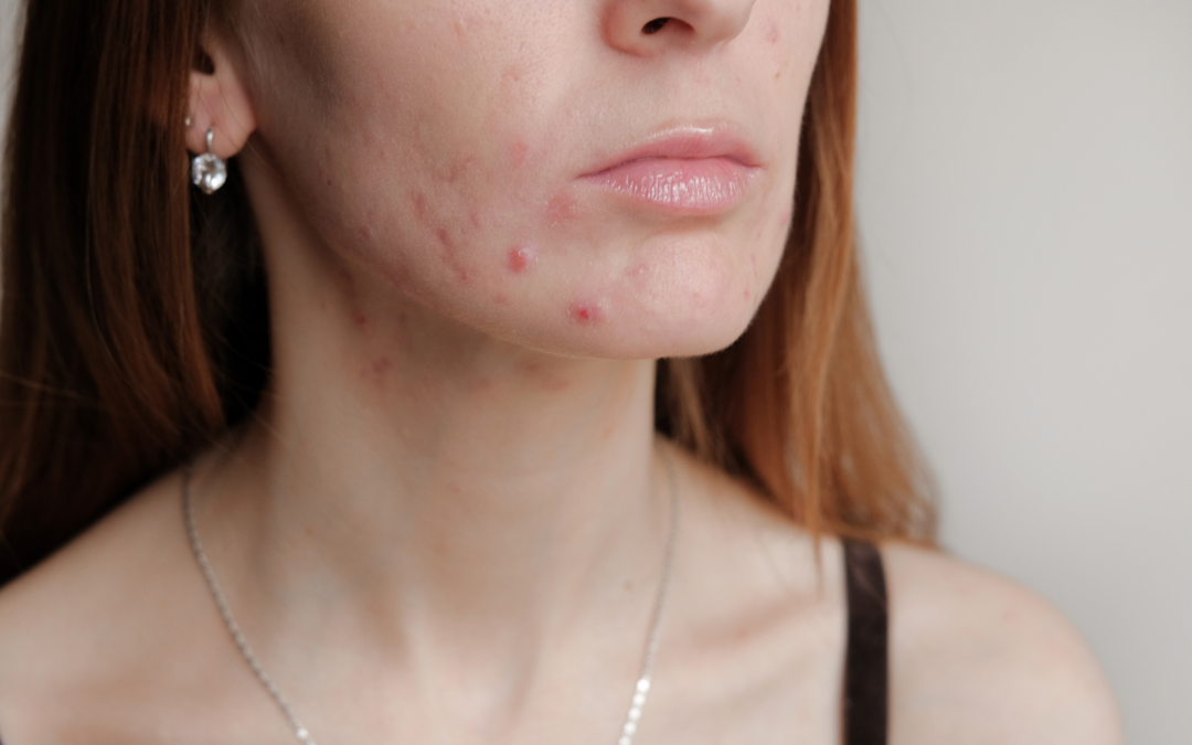 Why Do I Have Pregnancy Acne?